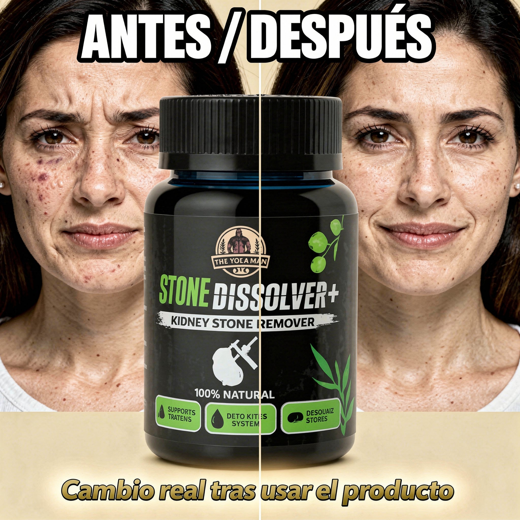 CALCULOS RENALES A1